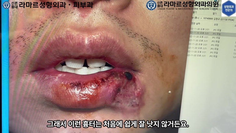 개에 물려 입술 1/3이 뜯긴 19세 남자분 치료 및 흉터 성형수술& 레이저 후기....! 관련 이미지 22