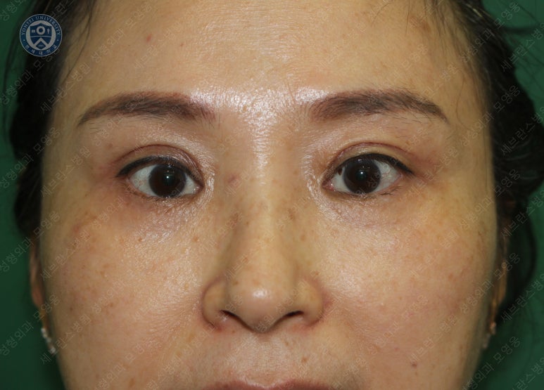 49세 여성, 토안이 있는 중년여성의 상안검성형술 (49/F, Upper blepharoplasty with lagophthalmos correction& LP) 관련 이미지 25