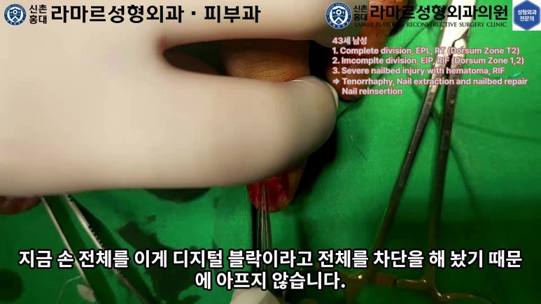 손가락 힘줄 손상 및 열상, 손톱 바닥 열상 처치 (Extensor tendon repair and nailbed injury treatment) 관련 이미지 16
