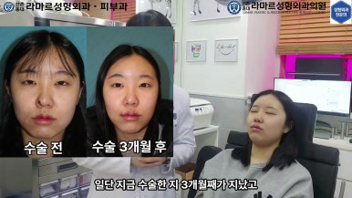 21세 여성 코 지름 1cm 점 제거수술 : 나선피판술(Spiral Flap) 수술전~5달 경과. (+쌍꺼풀수술, 코필러) 관련 이미지 17