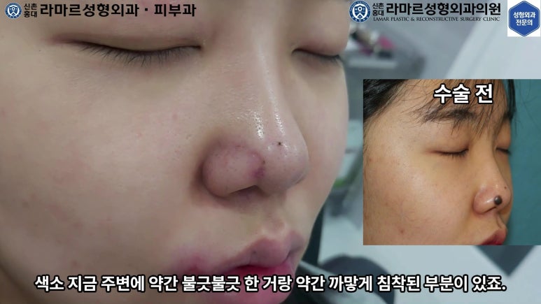 21세 여성 코 지름 1cm 점 제거수술 : 나선피판술(Spiral Flap) 수술전~5달 경과. (+쌍꺼풀수술, 코필러) 관련 이미지 22