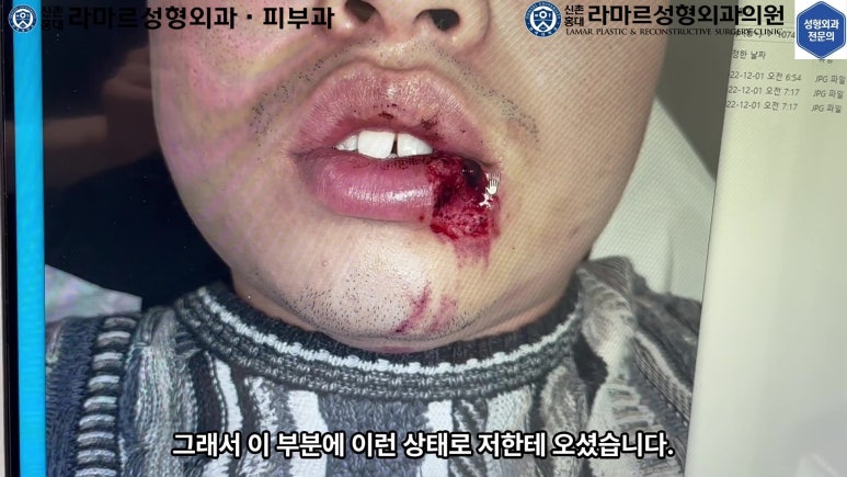 개에 물려 입술 1/3이 뜯긴 19세 남자분 치료 및 흉터 성형수술& 레이저 후기....! 관련 이미지 20
