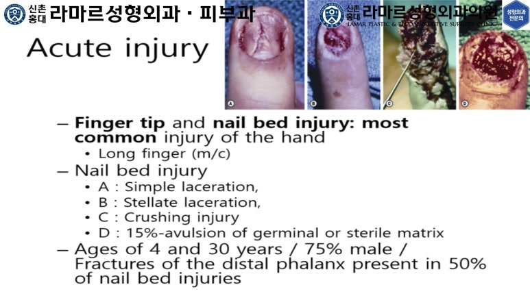 손가락 힘줄 손상 및 열상, 손톱 바닥 열상 처치 (Extensor tendon repair and nailbed injury treatment) 관련 이미지 12