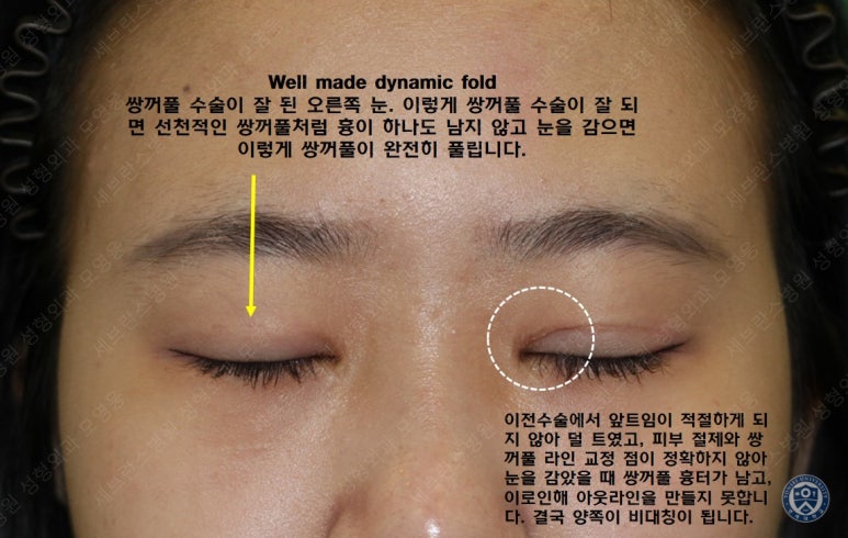 17세 여성, 비절개 눈매교정 및 앞트임 재수술 (17/F NI ptosis correction & Med. epicanthoplasty revision) 증례 관련 이미지 6