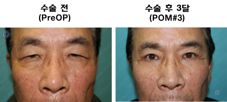67세 남성, 상&middot;하안검성형술 및 안검하수교정 (67/M, Upper &  lower blepharoplasty with ptosis correction) 관련 이미지 45