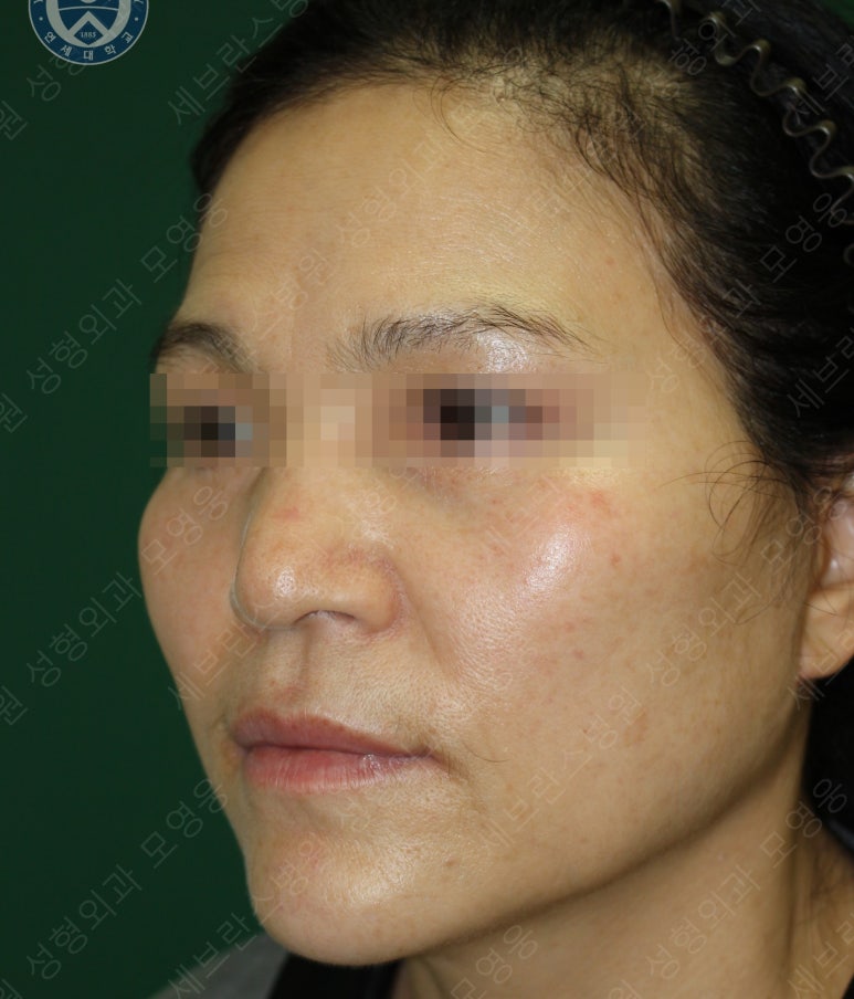 55세 여성, 이중평면 안면거상(55/F, Dual-plane full facelift) 관련 이미지 52