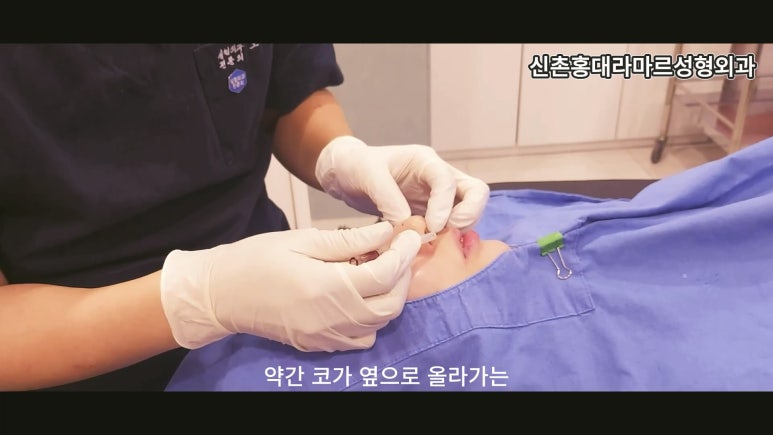 31세 여성 최소침습 하이코 코끝성형 관련 이미지 6