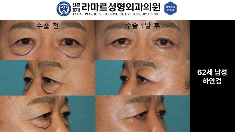 30대~80대 눈 수술 케이스 : 하안검성형술 전후 사진 모음 관련 이미지 9