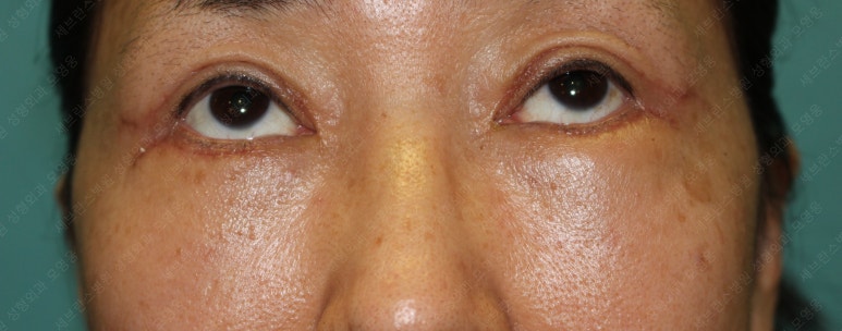 55세 여성, 상안검 및 하안검 성형술 증례 (55/F Upper & lower blepharoplasty) 관련 이미지 15