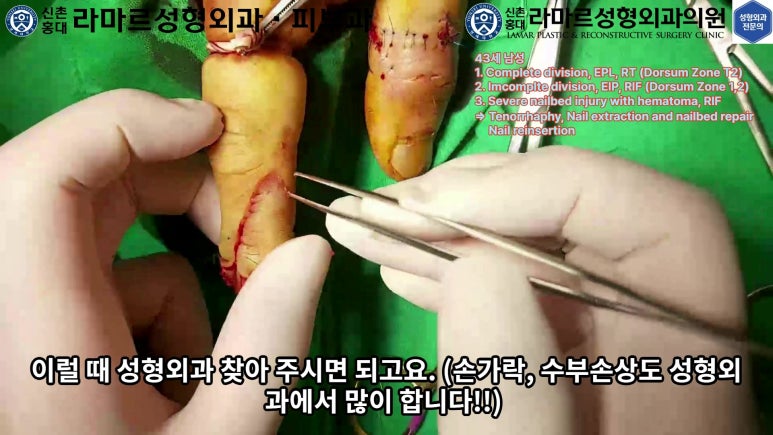 손가락 힘줄 손상 및 열상, 손톱 바닥 열상 처치 (Extensor tendon repair and nailbed injury treatment) 관련 이미지 20
