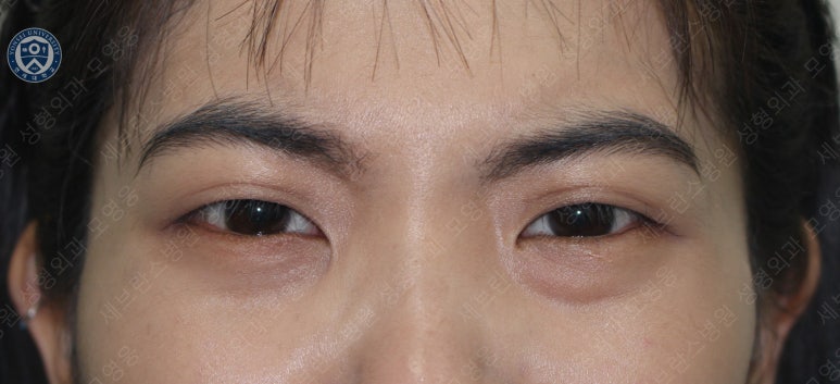 28세 여성, 눈밑지방재배치(눈밑지, 28/F Transconjunctival septal fat redraping-internal fixation technique) 관련 이미지 27