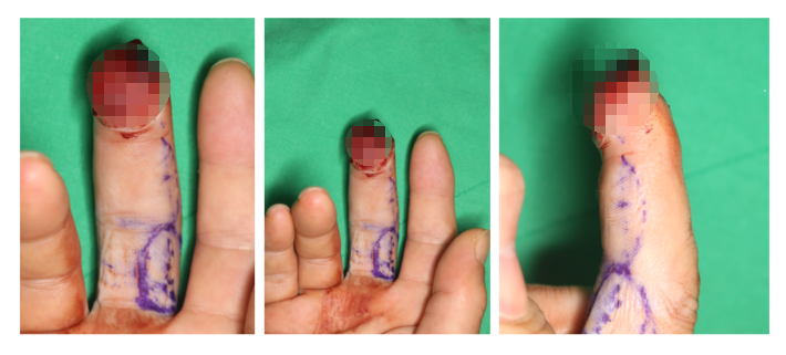 수지 말단부 절단에 시행한 동측 역행성 유경피판술 증례 (Homodigital Reverse Island Flap for Fingertip Amputation) 관련 이미지 4