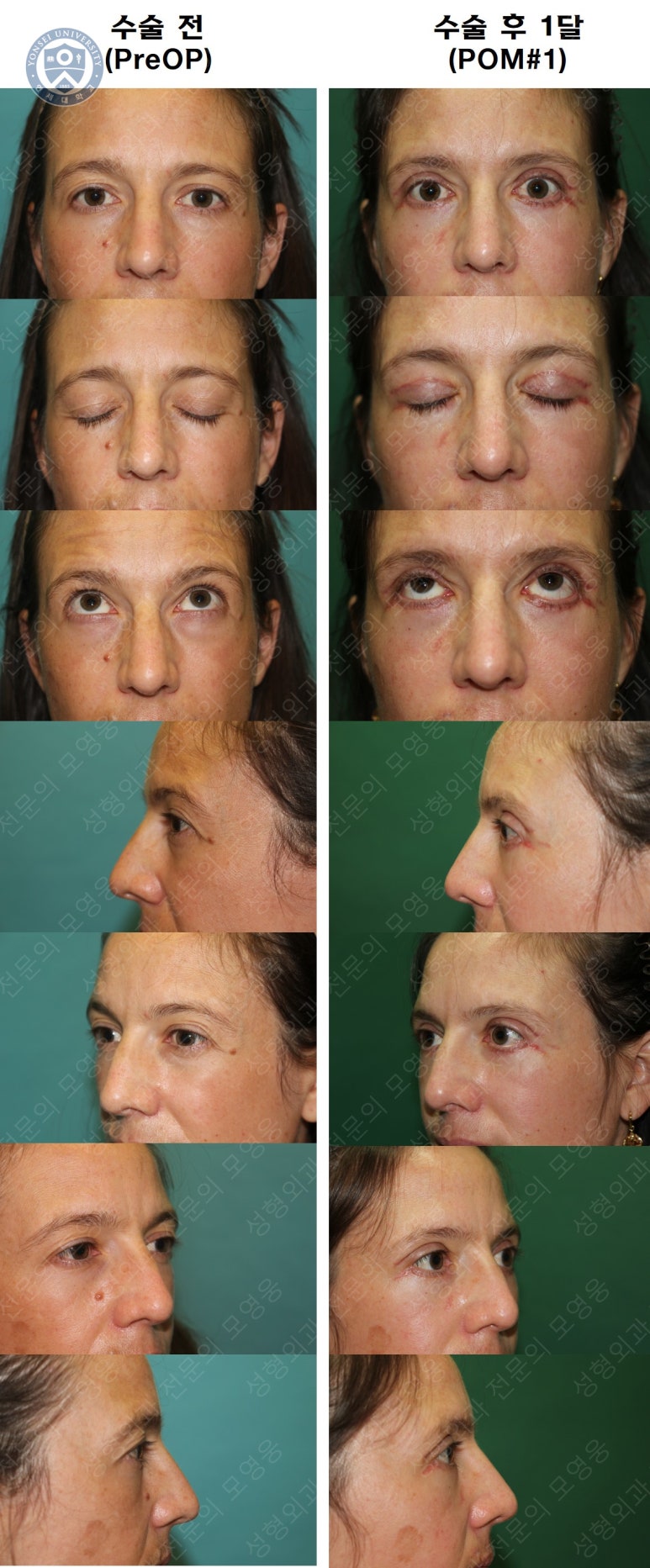 38세 서양 백인 여성, 쌍꺼풀 수술과 눈매교정 및 하안검성형술 (38/F Upper&lower blepharoplasty with levator plication) 관련 이미지 38