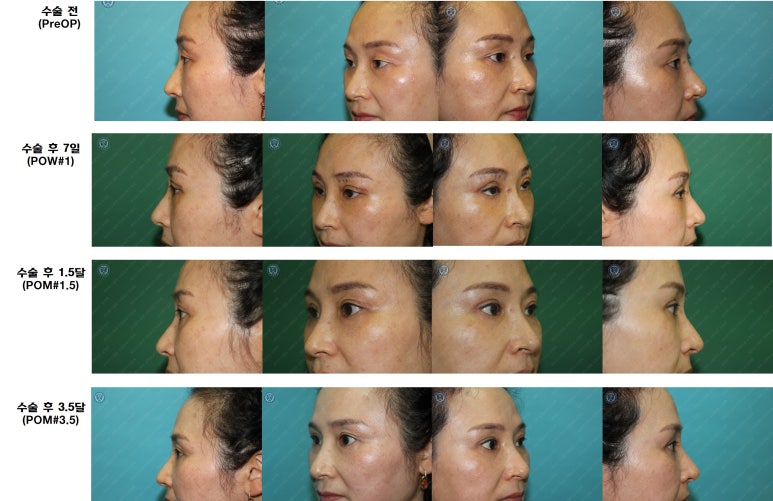 49세 여성, 토안이 있는 중년여성의 상안검성형술 (49/F, Upper blepharoplasty with lagophthalmos correction& LP) 관련 이미지 45