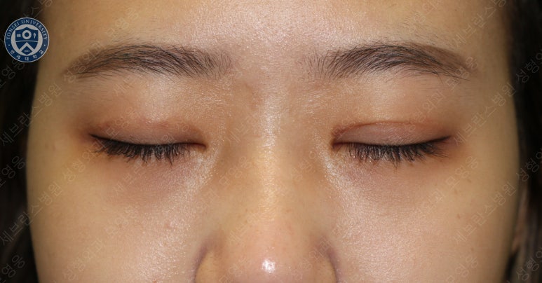 17세 여성, 비절개 눈매교정 및 앞트임 재수술 (17/F NI ptosis correction & Med. epicanthoplasty revision) 증례 관련 이미지 15