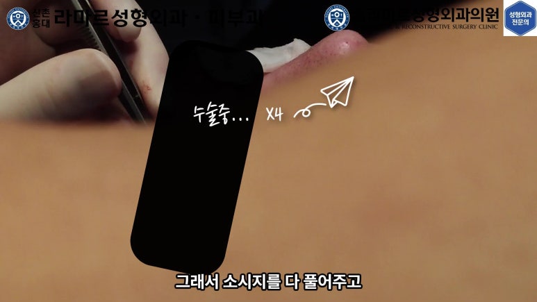 29세 남자, 소시지 쌍꺼풀 두줄따기로 낮추기 (쌍꺼풀 재수술) 관련 이미지 32