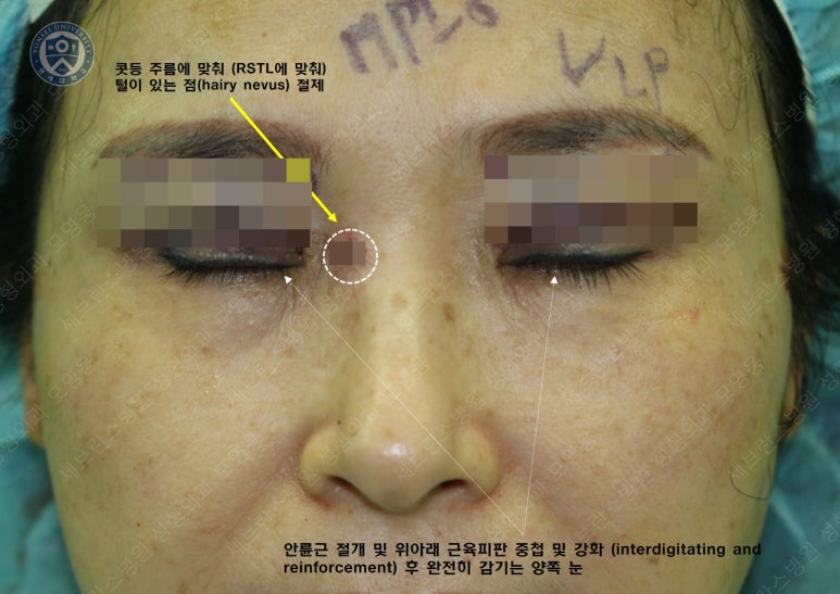 49세 여성, 토안이 있는 중년여성의 상안검성형술 (49/F, Upper blepharoplasty with lagophthalmos correction& LP) 관련 이미지 15