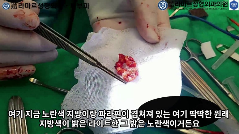 파라핀 필러 입 안 절개로 흉터없이 빼내기! 관련 이미지 49
