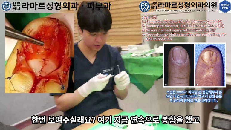 손가락 힘줄 손상 및 열상, 손톱 바닥 열상 처치 (Extensor tendon repair and nailbed injury treatment) 관련 이미지 25