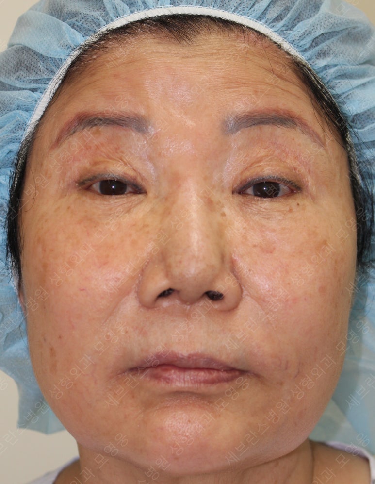 71세 여성, 이마거상술과 이마축소술 (71/F, Forehead lift and reduction) 관련 이미지 53