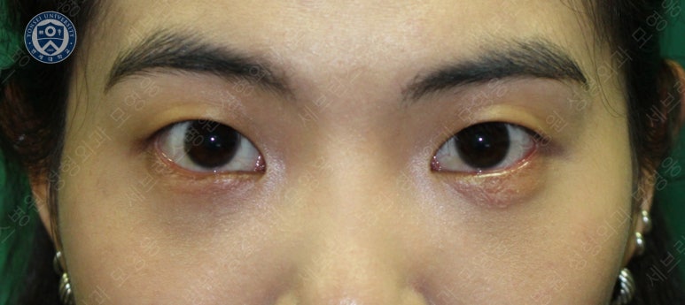 28세 여성, 눈밑지방재배치(눈밑지, 28/F Transconjunctival septal fat redraping-internal fixation technique) 관련 이미지 18