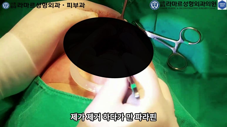 파라핀 필러 입 안 절개로 흉터없이 빼내기! 관련 이미지 72