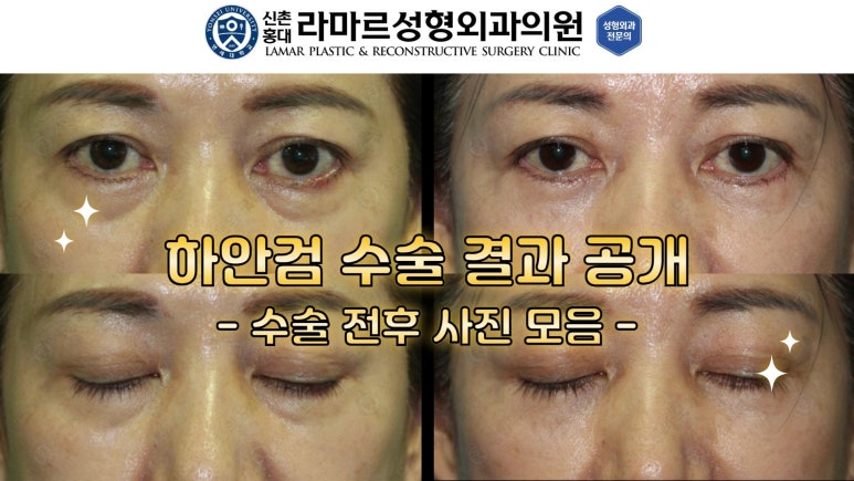 30대~80대 눈 수술 케이스 : 하안검성형술 전후 사진 모음 관련 이미지 5