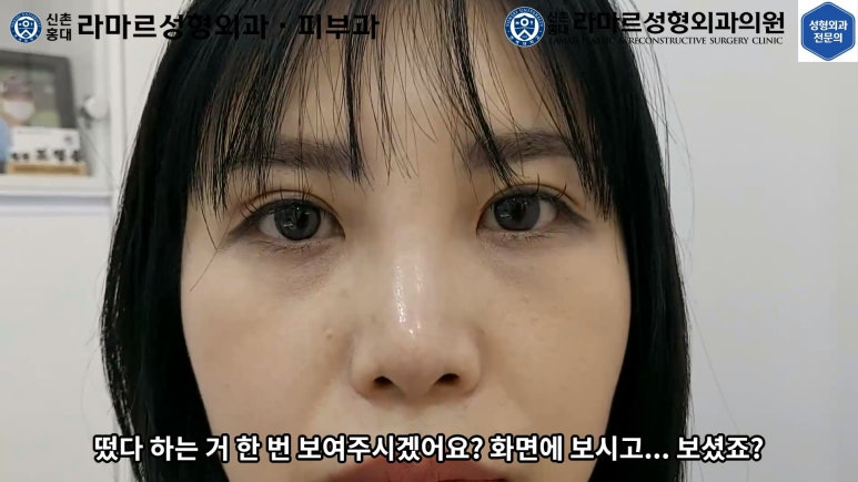 30대 여성 "쌍꺼풀+눈매교정" 상담, 디자인, 수술 전체 과정, 결과, 경과 모두 공개합니다. 관련 이미지 55