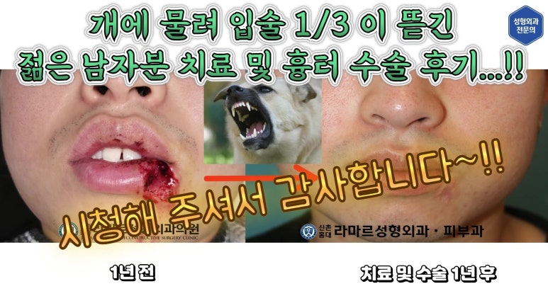 개에 물려 입술 1/3이 뜯긴 19세 남자분 치료 및 흉터 성형수술& 레이저 후기....! 관련 이미지 101