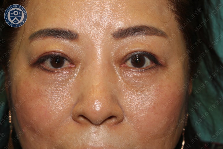 60세 여성, 상안검 및 하안검 성형술 증례 (60/F Upper & lower blepharoplasty) 관련 이미지 23