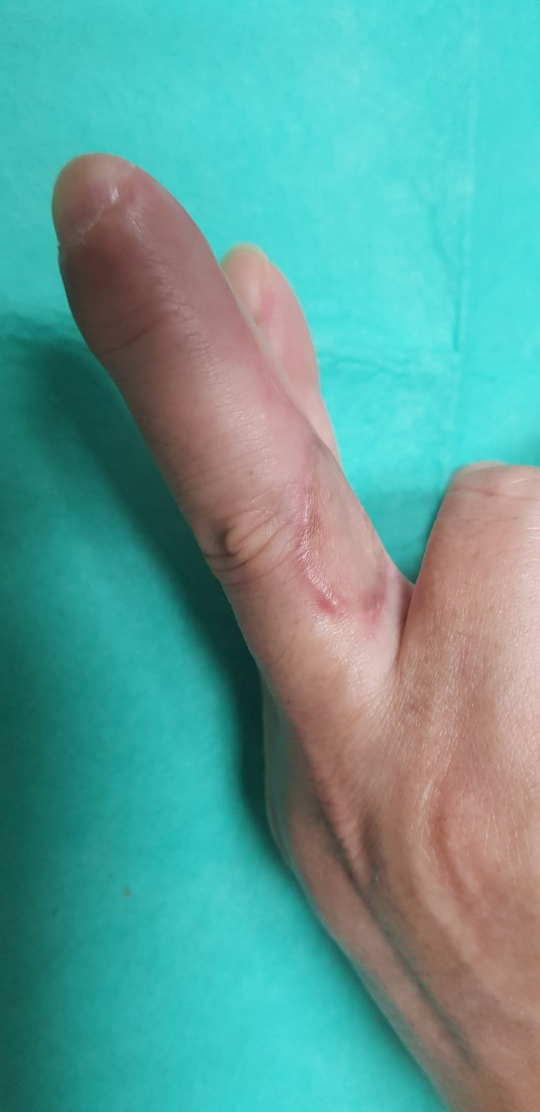 수지 말단부 절단에 시행한 동측 역행성 유경피판술 증례 (Homodigital Reverse Island Flap for Fingertip Amputation) 관련 이미지 13