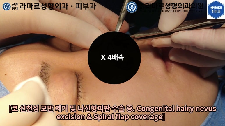 지름 1cm 코 점 제거수술 : 나선피판술(Spiral Flap) 수술전~1달 경과. (Feat. 턱끝필러+사각턱 보톡스) 관련 이미지 61