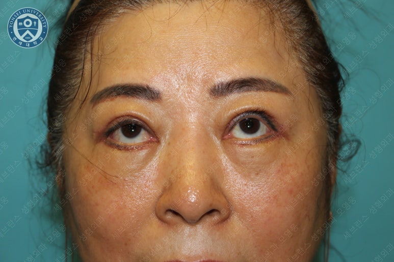 60세 여성, 상안검 및 하안검 성형술 증례 (60/F Upper & lower blepharoplasty) 관련 이미지 17