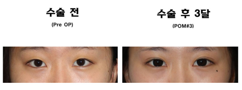 17세 여성, 쌍꺼풀+앞트임(DEO+Medial epicanthoplasty) 관련 이미지 40