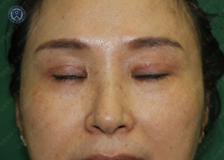 49세 여성, 토안이 있는 중년여성의 상안검성형술 (49/F, Upper blepharoplasty with lagophthalmos correction& LP) 관련 이미지 26