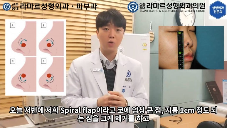지름 1cm 코 점 제거수술 : 나선피판술(Spiral Flap) 수술전~1달 경과. (Feat. 턱끝필러+사각턱 보톡스) 관련 이미지 146