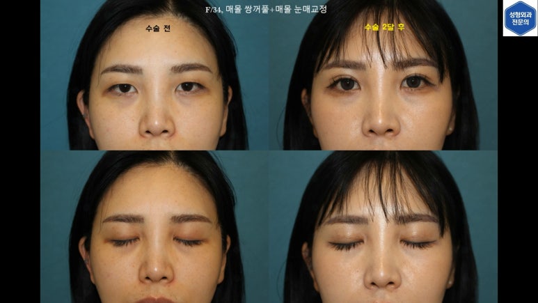 30대 여성 "쌍꺼풀+눈매교정" 상담, 디자인, 수술 전체 과정, 결과, 경과 모두 공개합니다. 관련 이미지 91