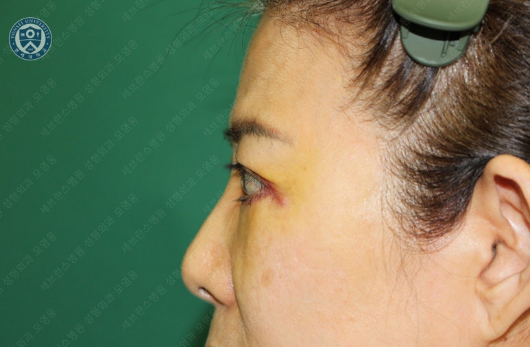 59세 여성, 그레이브스 안병증이 있는 돌출눈 중년 여성 하안검 성형술 (Lower blepharoplasty in Graves 관련 이미지 13