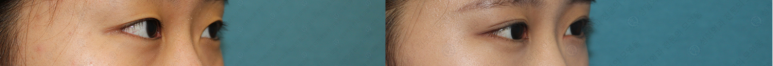 17세 여성, 쌍꺼풀+앞트임(DEO+Medial epicanthoplasty) 관련 이미지 58