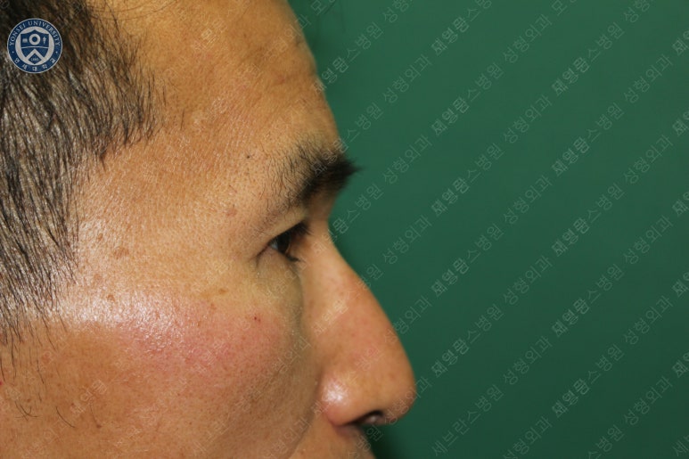 남자눈성형: 무쌍눈매교정 (Blephroptosis correction-levator aponeurosis advancement) 관련 이미지 36