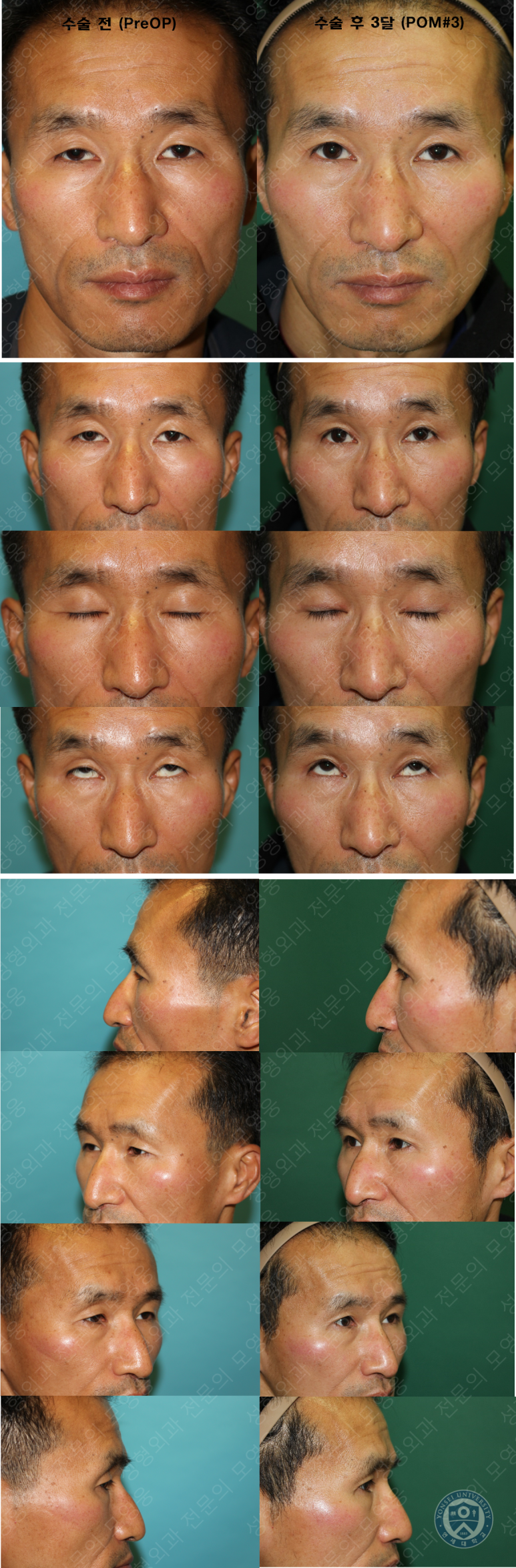 남자눈성형: 무쌍눈매교정 (Blephroptosis correction-levator aponeurosis advancement) 관련 이미지 46