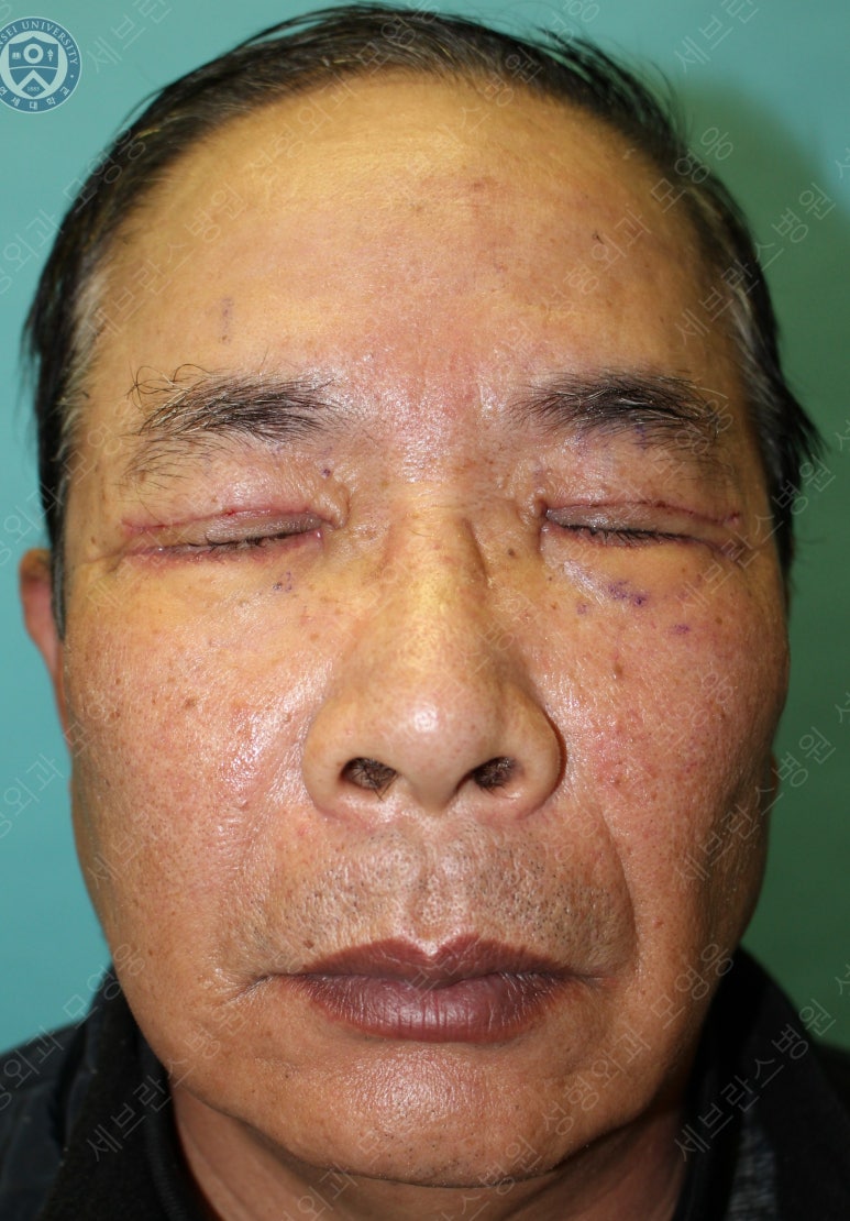 67세 남성, 상&middot;하안검성형술 및 안검하수교정 (67/M, Upper &  lower blepharoplasty with ptosis correction) 관련 이미지 20