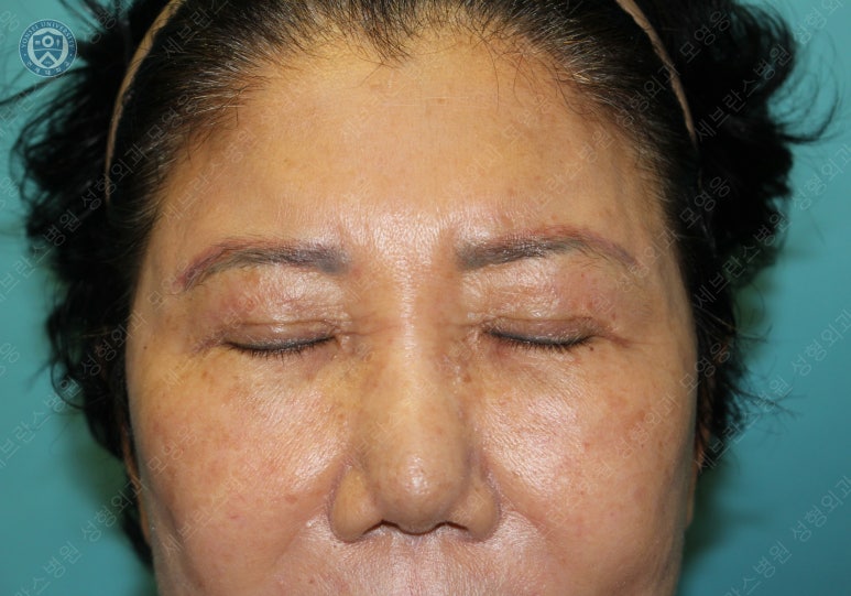 71세 여성, 이마거상술과 이마축소술 (71/F, Forehead lift and reduction) 관련 이미지 5