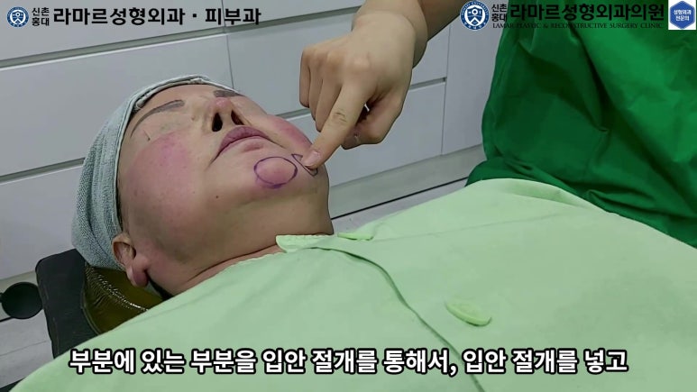 파라핀 필러 입 안 절개로 흉터없이 빼내기! 관련 이미지 18