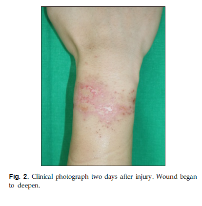 JKBS-Deep Second Degree Burn of Ferrous Chloride in a Worker at a Wastewater Treatment Facility 관련 이미지 4