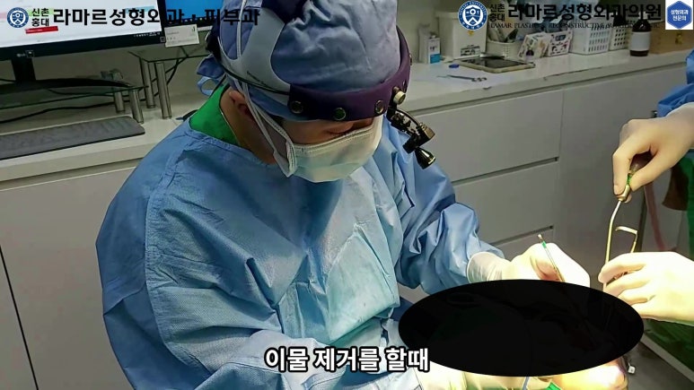 파라핀 필러 입 안 절개로 흉터없이 빼내기! 관련 이미지 33