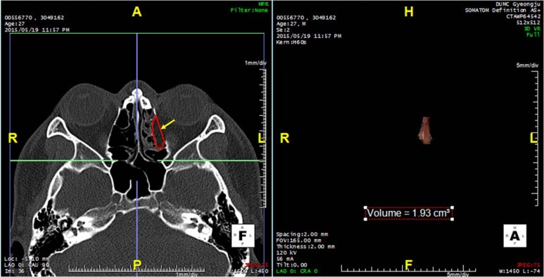 JPRAS-Prediction of late enophthalmos using quantitative measures in isolated med. orbital wall Fx. 관련 이미지 3