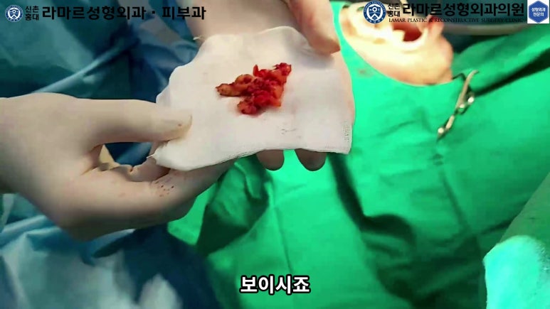 파라핀 필러 입 안 절개로 흉터없이 빼내기! 관련 이미지 70