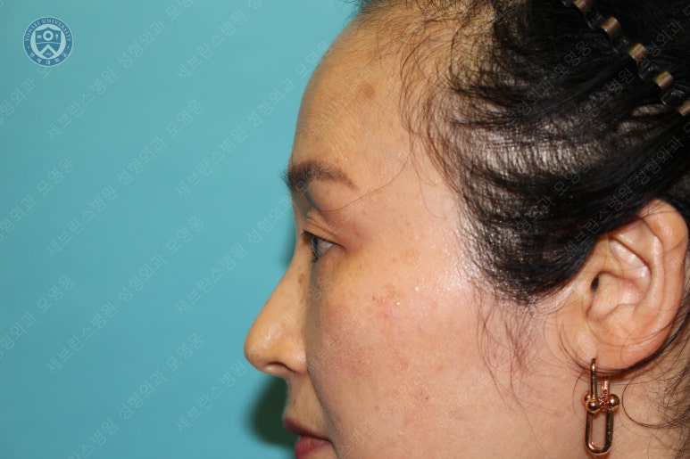 49세 여성, 토안이 있는 중년여성의 상안검성형술 (49/F, Upper blepharoplasty with lagophthalmos correction& LP) 관련 이미지 6