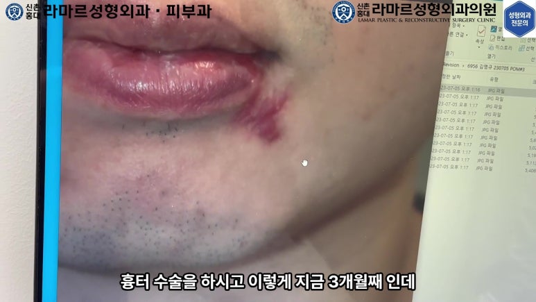 개에 물려 입술 1/3이 뜯긴 19세 남자분 치료 및 흉터 성형수술& 레이저 후기....! 관련 이미지 43